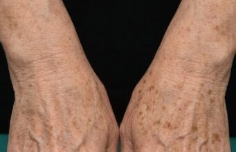 Viele Menschen schwören auf dieses unerwartete Hausmittel gegen Pigmentflecken (GENIAL!)